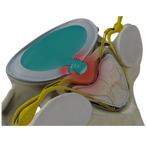 Cervical Disc Herniation