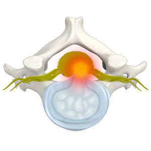 Cervical Disc Protrusion