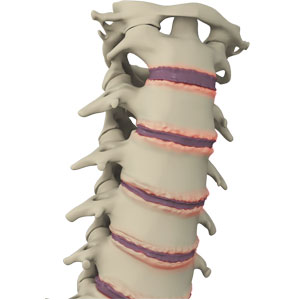 Cervical Spondylosis