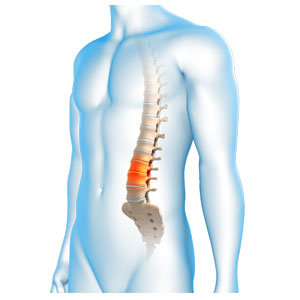 Degenerative Spinal Conditions