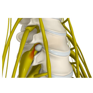 Lumbar Herniated Disc