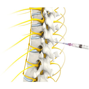 Epidural Steroid Injections