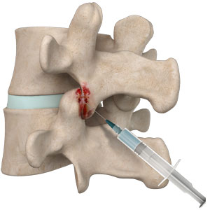 Facet Joint Injections