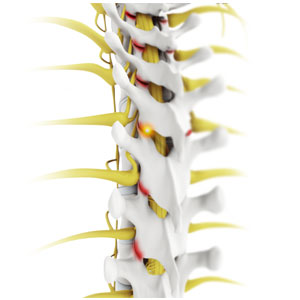 Facet Joint Arthritis