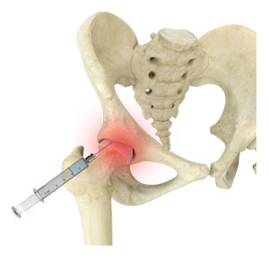 Hip Injections