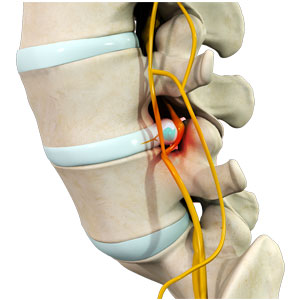 Lumbar Degenerative Problems