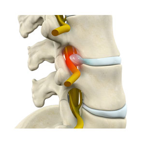 Lumbar Radiculopathy