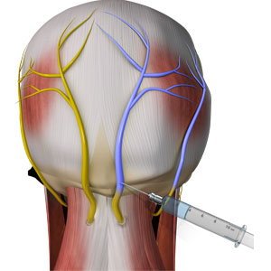 Occipital Nerve Blocks