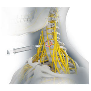 Peripheral Nerve Block