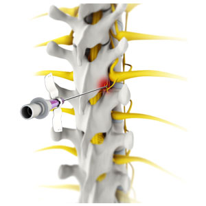 >Radiofrequency ablation