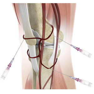 Genicular Nerve Radiofrequency Ablation