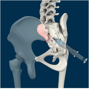 Sacroiliac Joint Injection