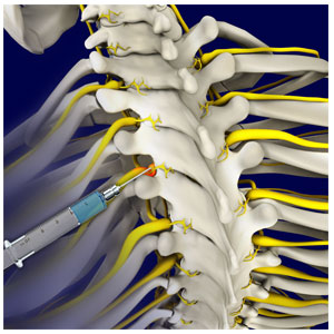 Selective Nerve Root Block