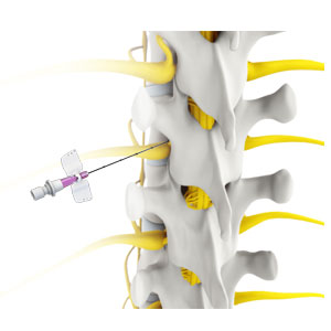 Transforaminal Epidural Steroid Injection